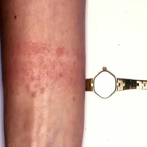Does Stainless Steel Irritate Skin? Understanding Stainless Steel Jewelry and Allergic Reactions